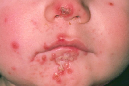Impetigo