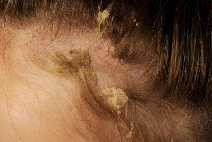 Scalp Psoriasis
